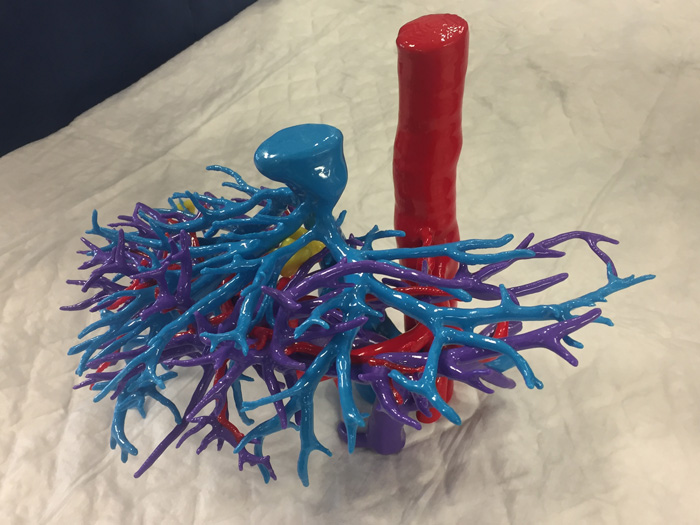 Modelo físico impreso en 3D del hígado y lesiones concretas de Ángel, el paciente intervenido