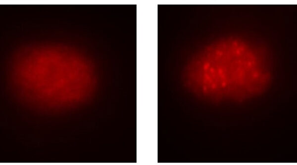 A la izquierda, célula de sangre de paciente afectado; a la derecha, corregida con el CRISPRCas9