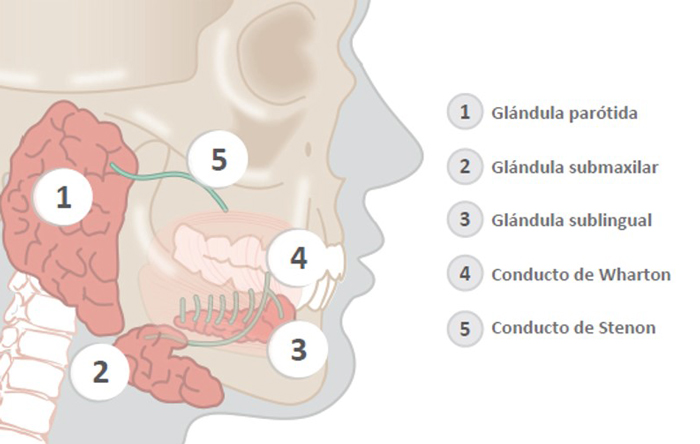 La sialoadenitis obstructiva crónica es la inflamación recurrente de las glándulas salivales