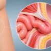 Operarse de una hernia y volver a casa el mismo día: cuándo es posible la cirugía ambulatoria
